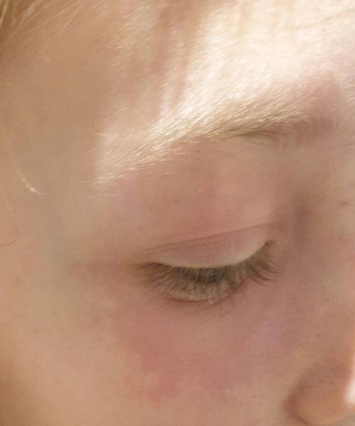 Dd13 skin reactions- photo incuded