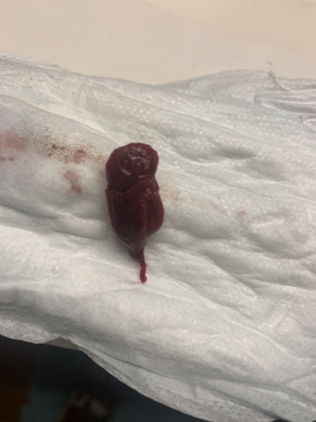 Miscarriage or not?