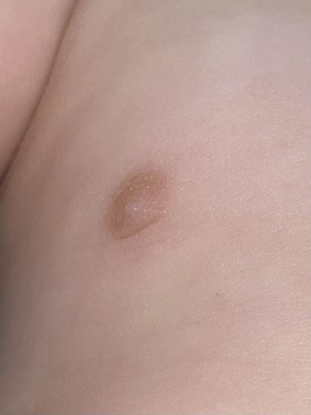 Worried about my 11 month olds nipples