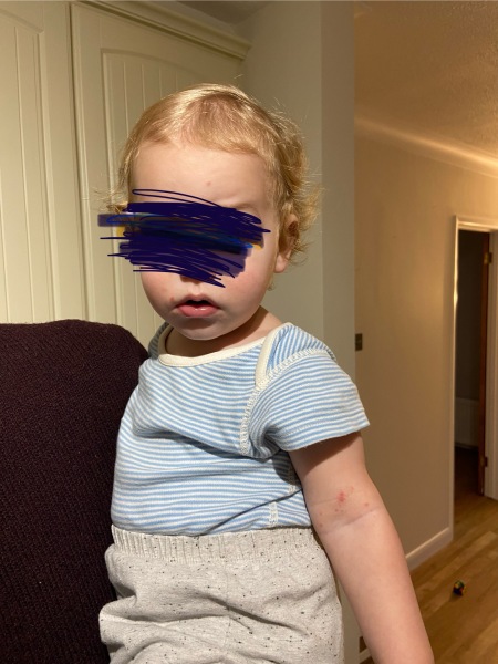 Impetigo, eczema or chicken pox?