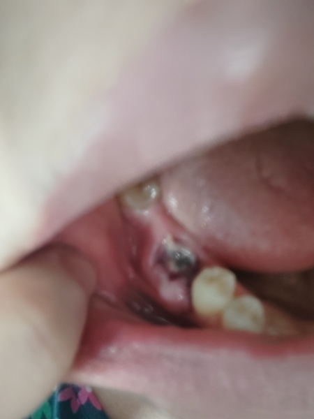 Tooth extraction