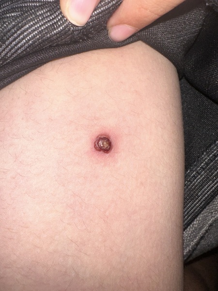 Infected molluscum contagiosum or something else?