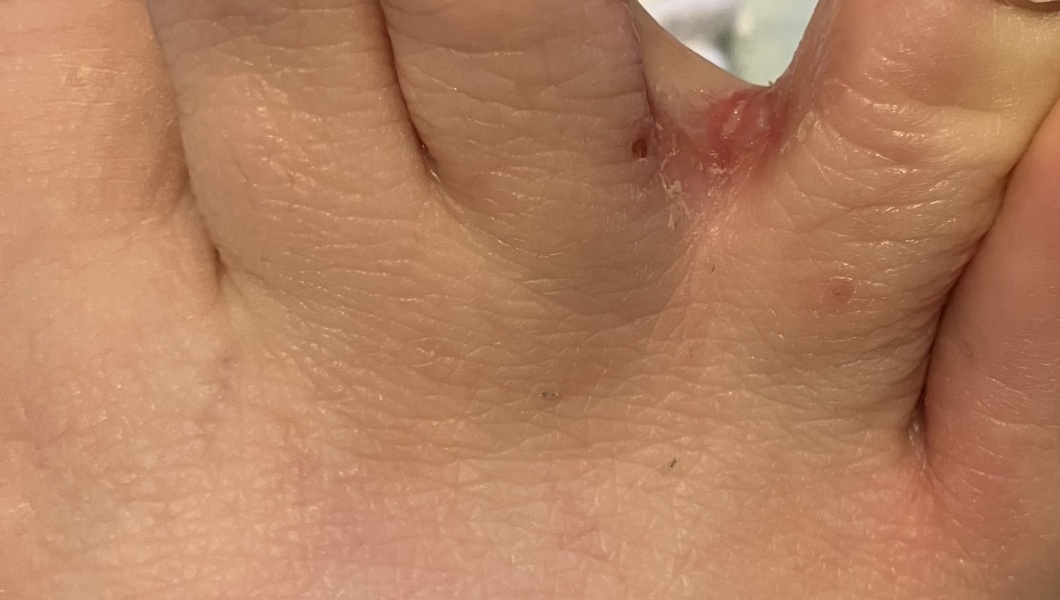 If it’s not athlete’s foot, what is it?