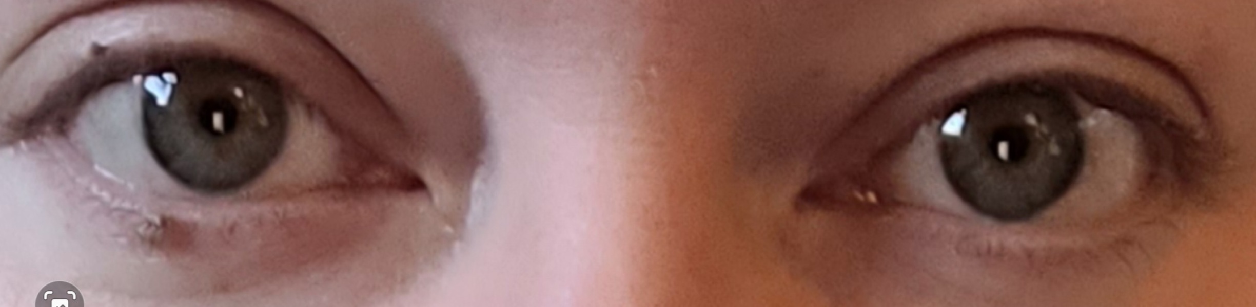 I think I have mild strabismus, opinions please