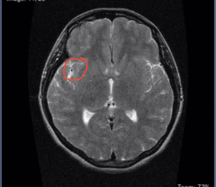 anyone know this?Brain MRI question?