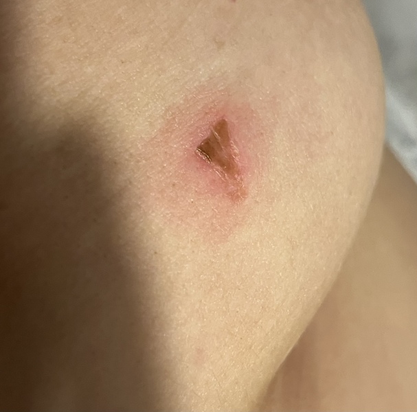 Lesion on breast, photo attached.