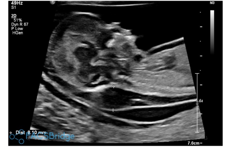 8.1 NT, no physical abnormalities, lots of excess fluid at 13 weeks