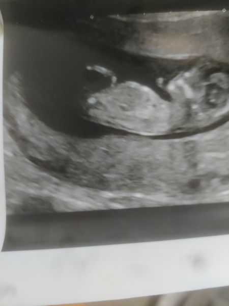 Any guesses boy or girl on my 12 weeks 6 days scan?