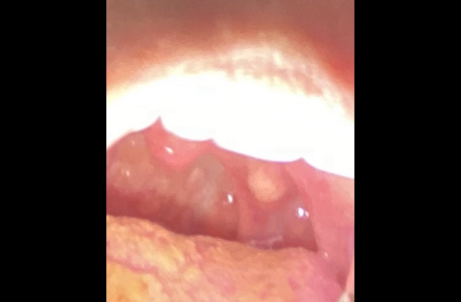 Can anyone tell me if this is a tonsil cyst?