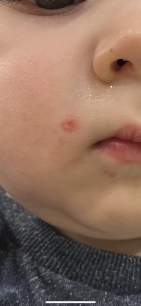 Chicken pox?