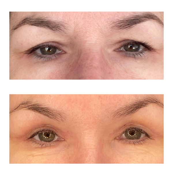 Upper Blepheroplasty