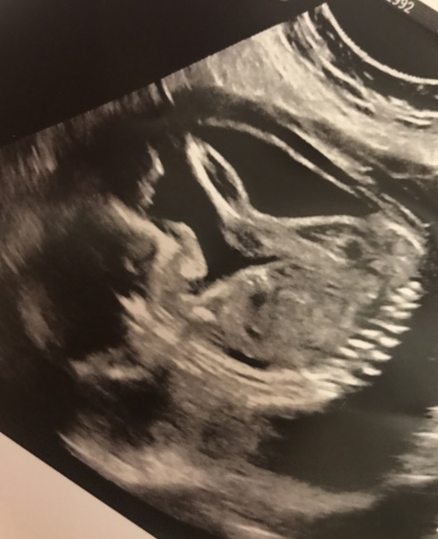 Nt not perform at 12 scan, mid term scan high measurement found