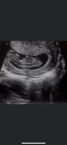 11 week private scan concern