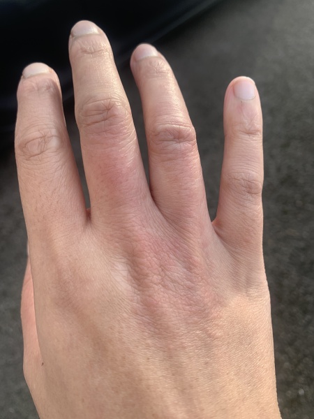 Hand eczema/pompholyx . Help! Trying to wean off steroid but keep reflaring!