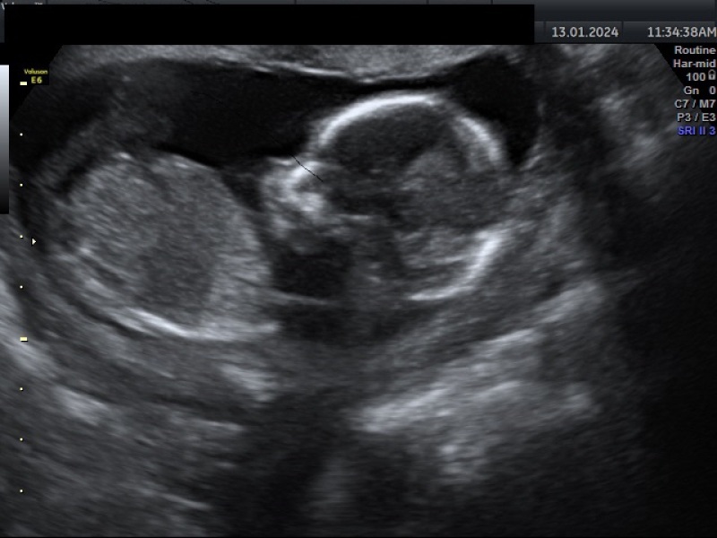 Gender guess - reveal tomorrow!