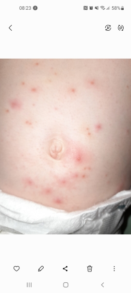 Is this chicken pox and does it always itch