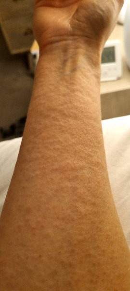 What is this rash?