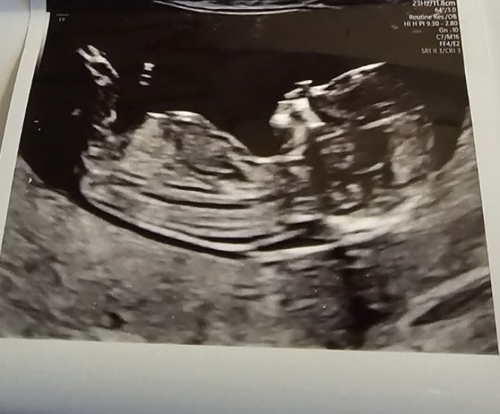 Just for fun! Nub theory 13 week scan