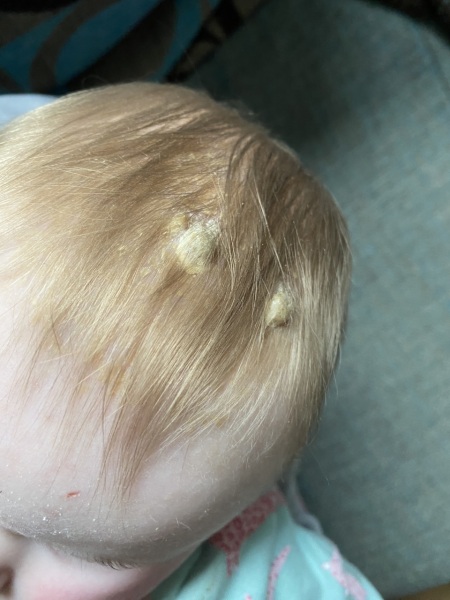 Cradle cap?