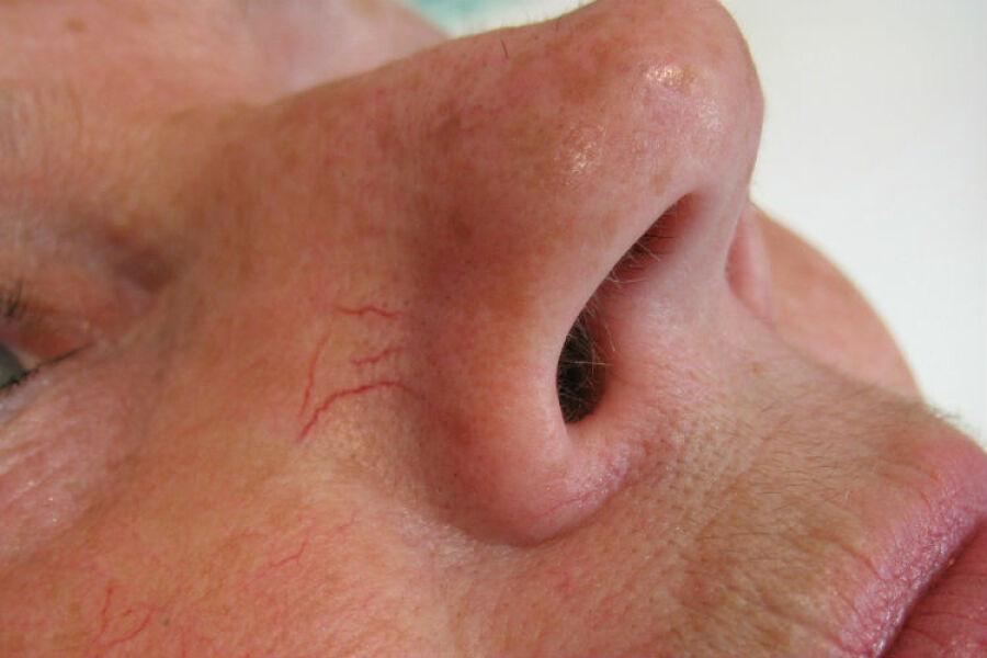Veins on side of nose?