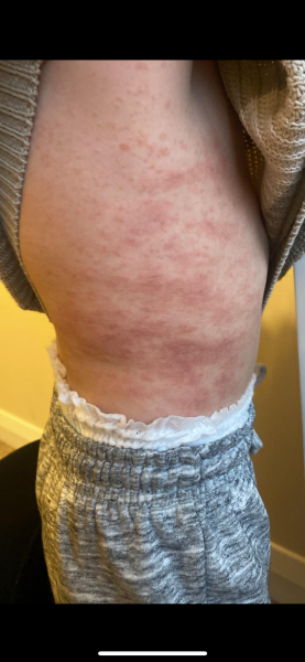 Rash , allergic reaction , Scarlett fever ????