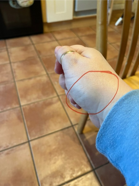 Is it possible to break a bone & not know?
