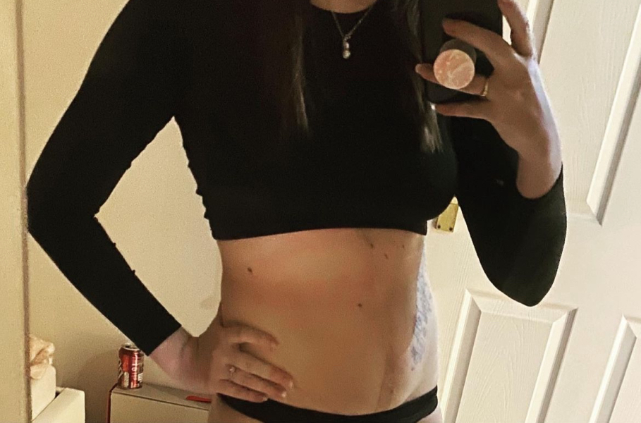 Following on from my accident post - now scars!