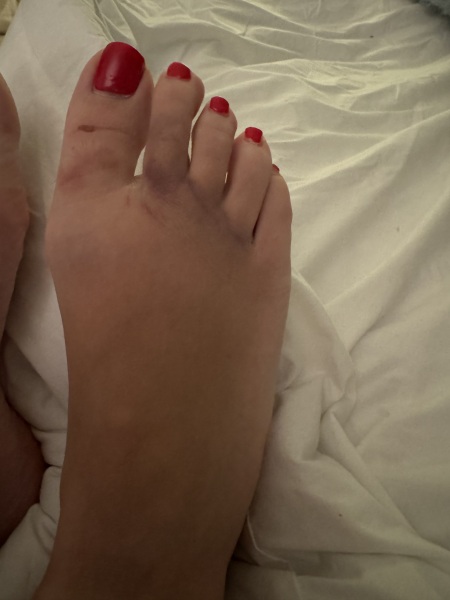 Broken toe? Foot?