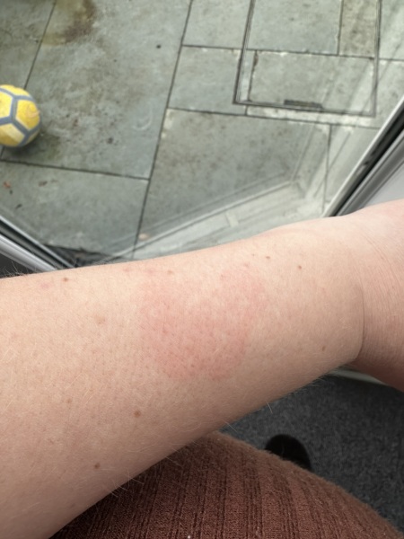 What this come up on my arm pics
