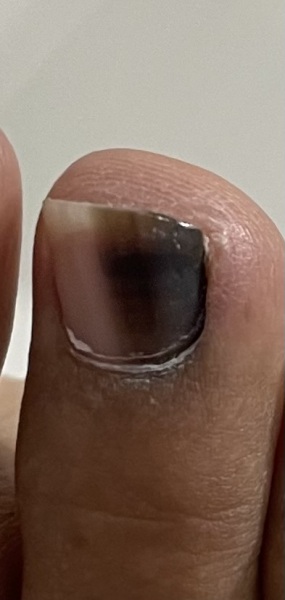 Toe melanoma or normal?