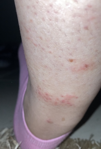 I have folliculitis on my lower left leg, and some red freckles on my right leg? Is this cause for concern?