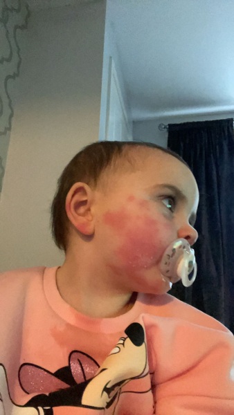 What could this rash be?