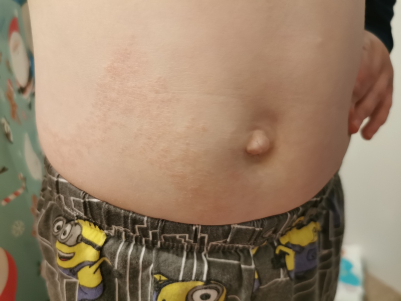 Rash