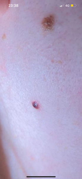 To think this is melanoma