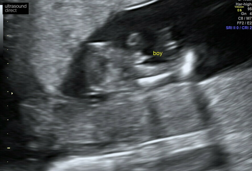 Gender confirmation