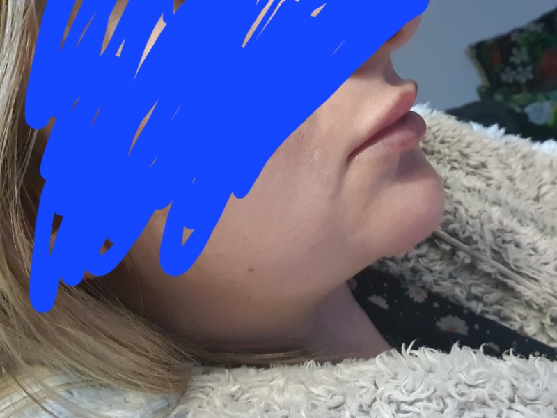 How can filler have permanently changed my lips?