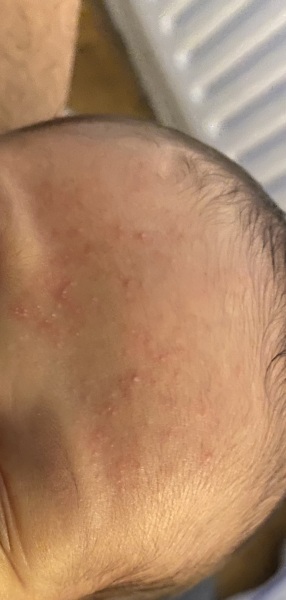 Baby acne??