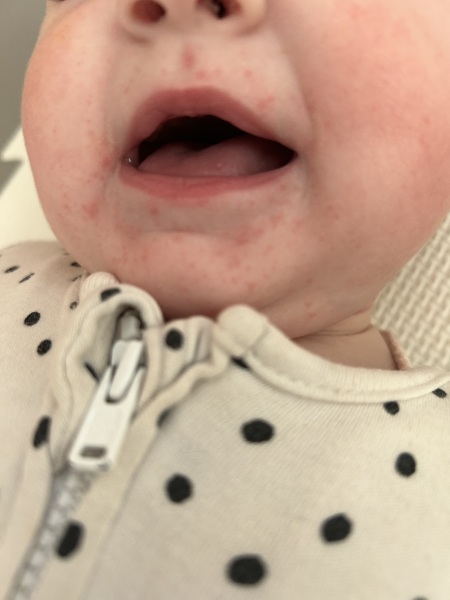 Baby potential egg allergy