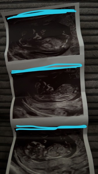 Baby gender
