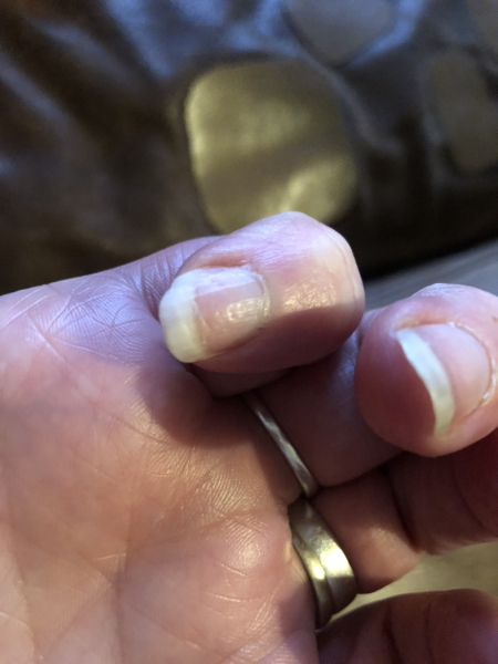 Dents in nails