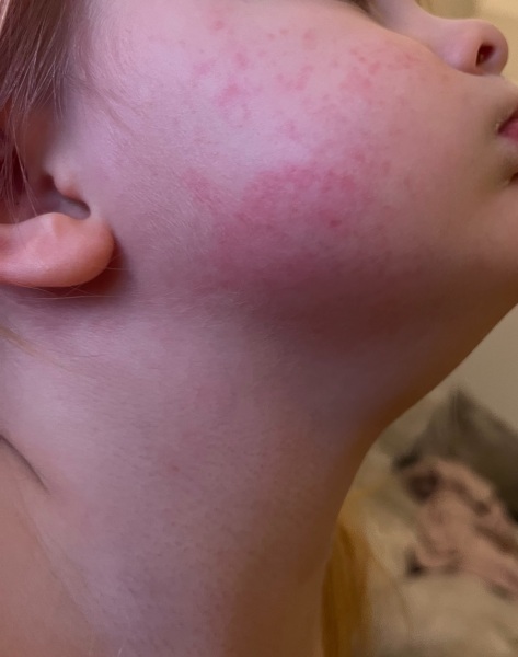 Anyone help with this rash please?