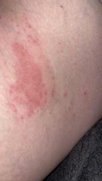 Ideas on this rash