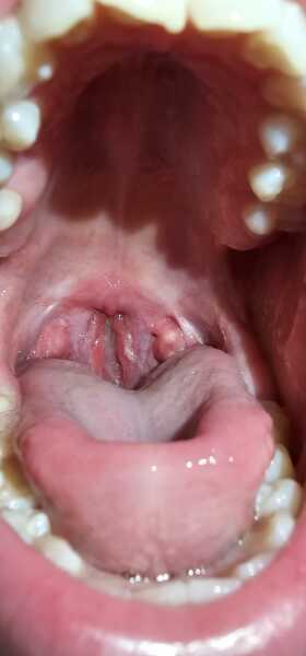 Throat Lumps and Severe Pain