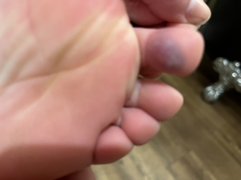 I think DD(11) has chillblains. How do I treat them?
