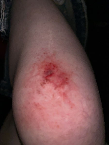 Sorry for posting AIBU, but could this cut need stitches??