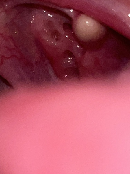 Potential tonsil cyst