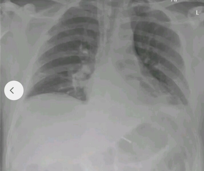 Anyone else had a pulmonary embolism? Hand hold needed.