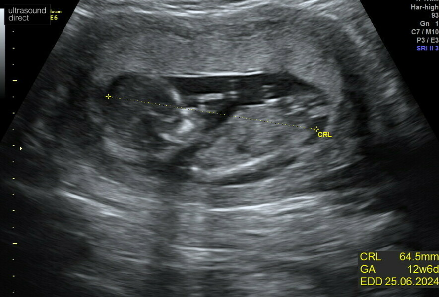 Is there a nub in this scan pic?