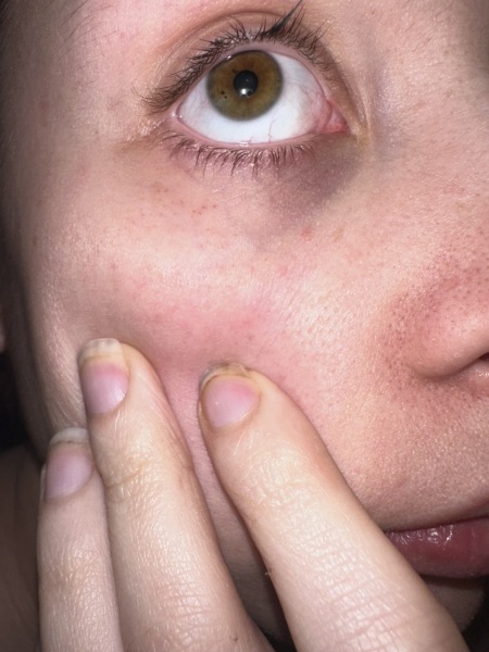 Petachaie / blood spots around eyes.. advice