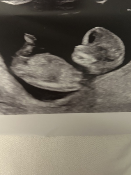 12 week scan fun nub guesses